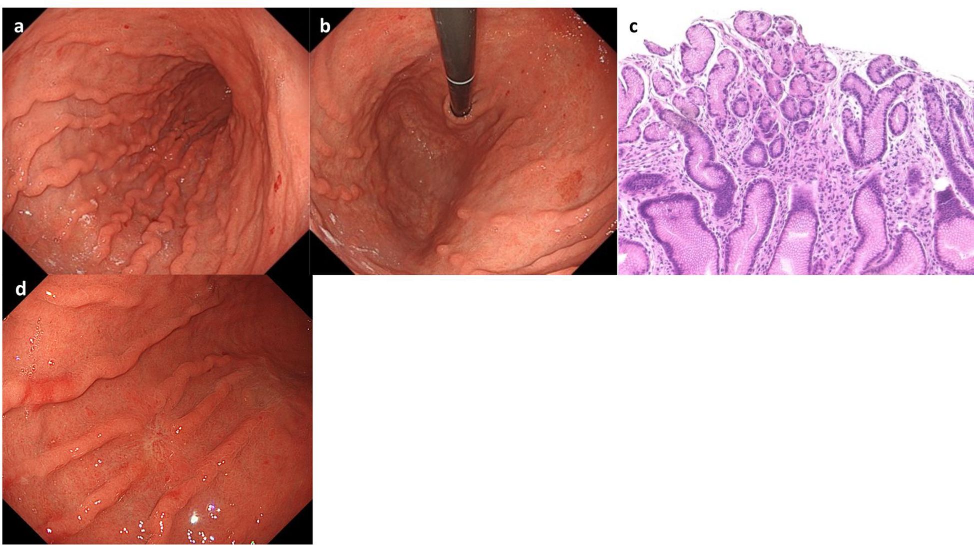 Gastrointestinal endoscopy and histology images of the duodenum. Panel a shows the typical scalloping and nodularity of the mucosa. Panel b depicts the endoscope advancing through the duodenum. Panel c is a histological section stained with hematoxylin and eosin, showing villous atrophy and crypt hyperplasia. Panel d illustrates a different view of the duodenal mucosa with subtle scalloping.