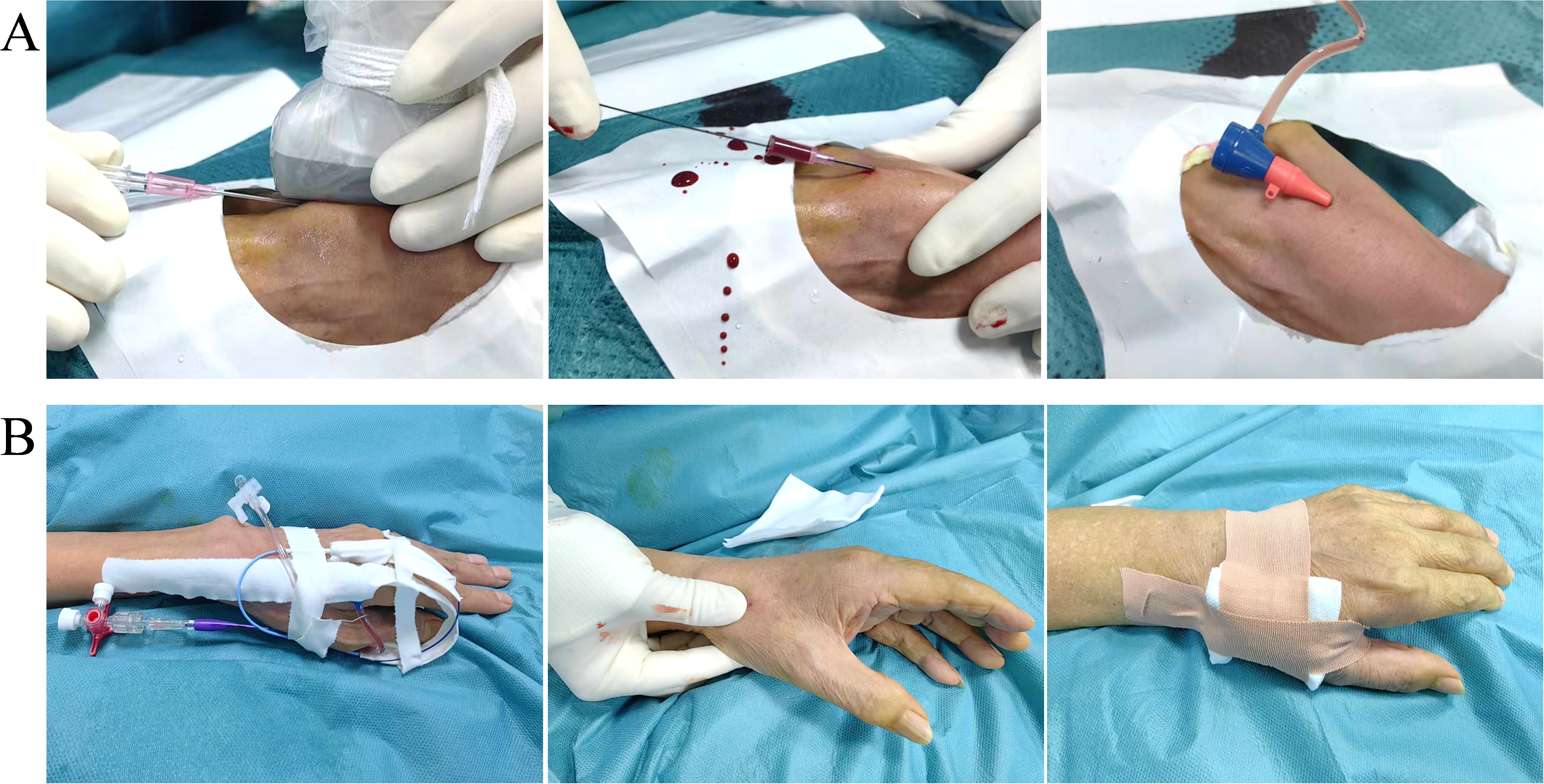 Panel A shows the process of performing a distal radial artery puncture under ultrasound guidance. Under the guidance of the ultrasound probe, a puncture needle is used to puncture the blood vessel (the distal radial artery), a guiding guidewire is inserted, following, a vascular sheath is placed. Figure B depicts the catheter fixation method by the distal radial artery approach and the process of catheter removal and compression for hemostasis after treatment.