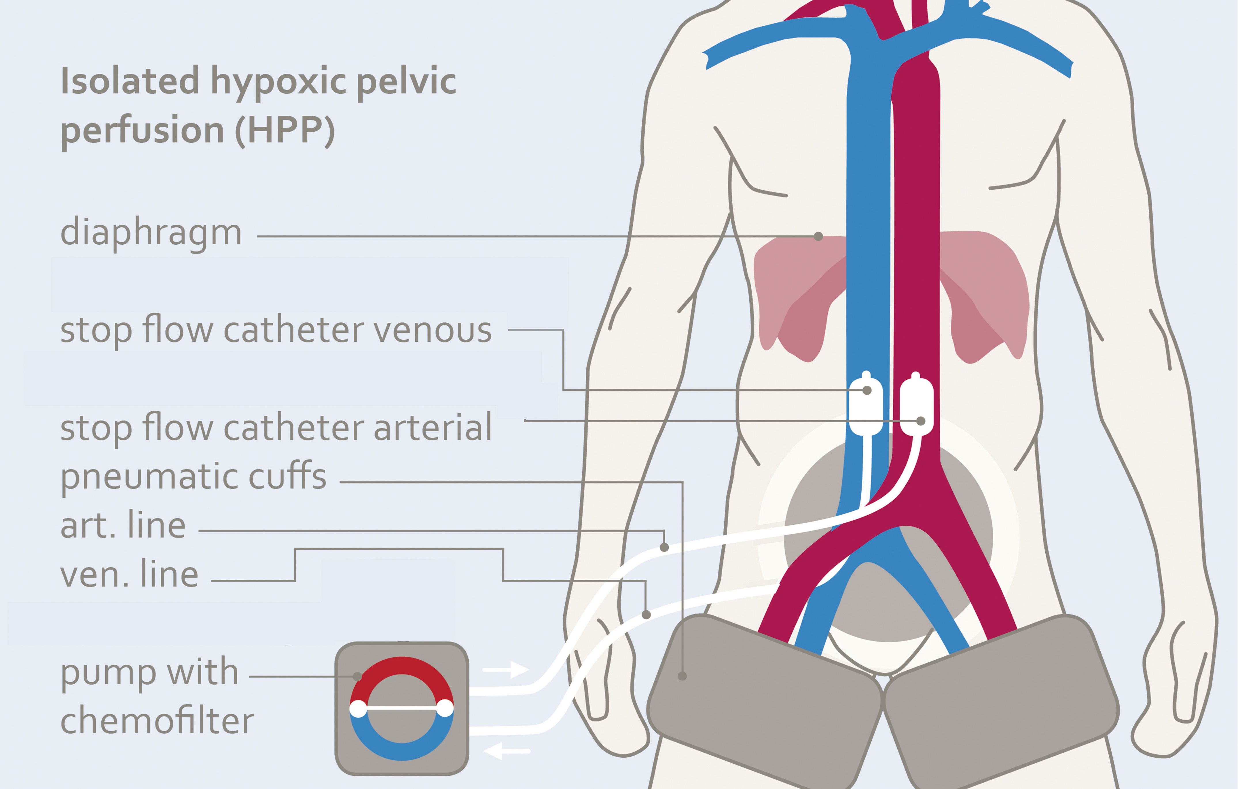 Diagram illustrating isolated hypoxic pelvic perfusion (HPP). It shows the positioning of catheters and pneumatic cuffs in the human body, highlighting the diaphragm, stop flow catheters for venous and arterial lines, and the pump with chemofilter. Pathways of blood flow are indicated in blue and red through the arteries and veins.