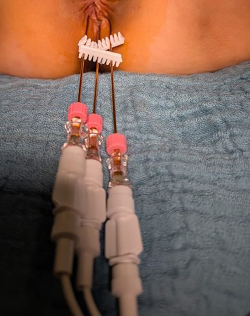 Medical procedure with three electrode needles inserted into tissue, supported by a plastic clamp. The setup is placed on a blue surgical drape, and wires extend from the electrodes.
