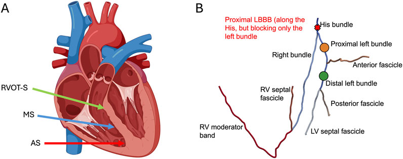 Diagram depicting the heart's conduction system divided into two panels. Panel A shows a cross-section of the heart highlighting the right ventricle outflow tract septum (RVOT-S), mid-septum (MS), and anterior septum (AS) with colored arrows. Panel B illustrates the His-Purkinje system, marking structures such as the His bundle, proximal and distal left bundles, right bundle, anterior and posterior fascicles, and right ventricle moderator band. A note indicates a proximal left bundle branch block along the His bundle but affecting only the left side.