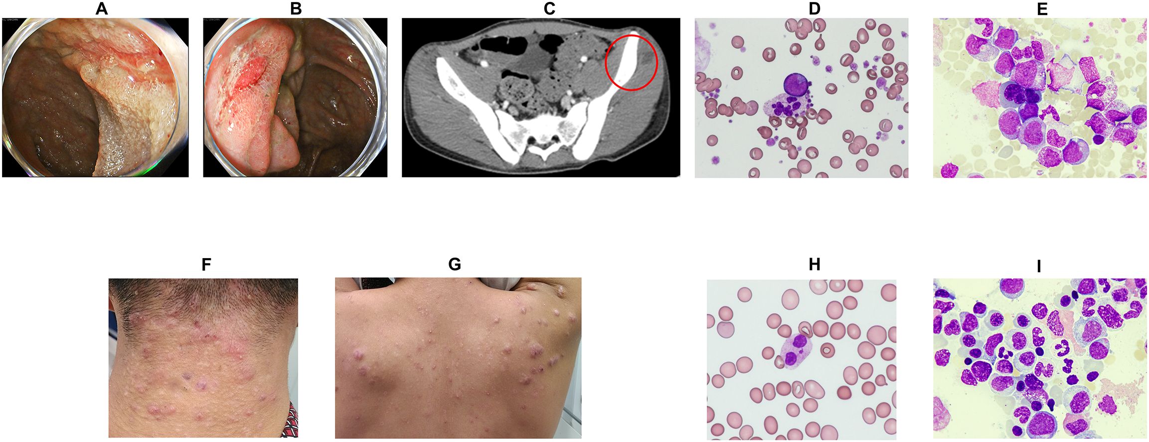 Panels A and B show lower gastrointestinal endoscopic images with mucosal changes. Panel C displays a CT image indicating a subcutaneous abscess in the abdomen. Panel D shows a peripheral blood smear, and Panel E presents a bone marrow smear, both revealing notable cellular morphology. Panels F and G depict the skin surface with multiple lesions or nodules. Panel H shows another peripheral blood smear, and Panel I shows a bone marrow smear, each with characteristic abnormal cells.
