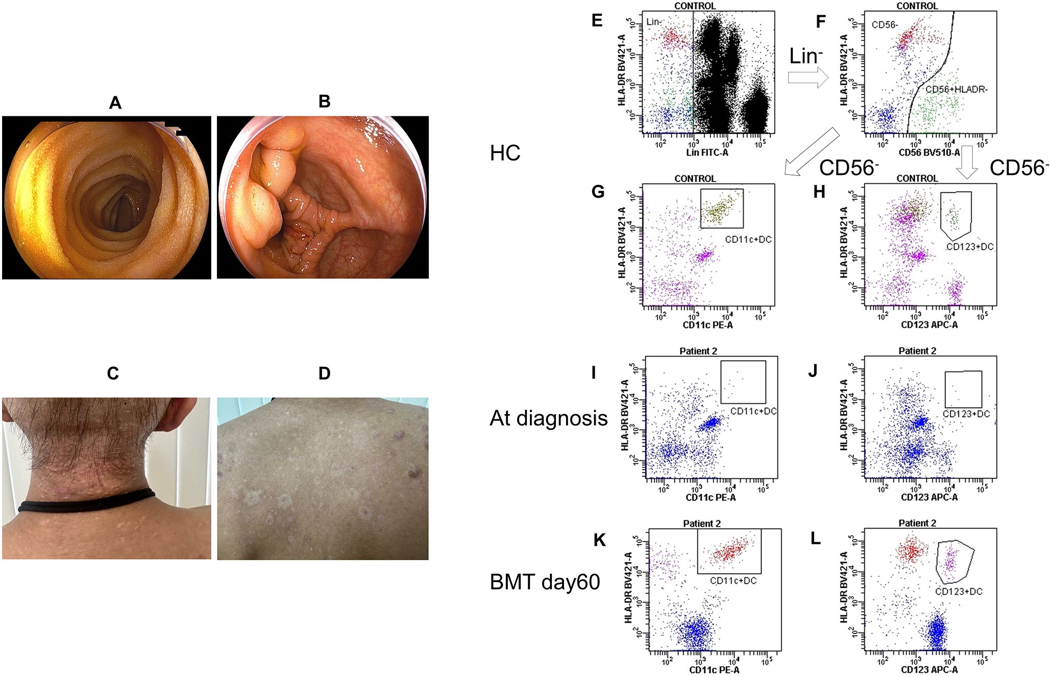 Panels A and B show endoscopic images of the colon after treatment, demonstrating improvement of mucosal lesions. Panels C and D depict the patient’s neck and back, showing improved skin findings. Panels E to L present flow cytometry plots comparing a healthy control (E to H) with Patient 2 at diagnosis and on day 60 after bone marrow transplantation (I to L). The plots analyze cell markers including CD56, CD11c+ dendritic cells (DCs), and CD123+ DCs, illustrating temporal changes over the course of treatment.