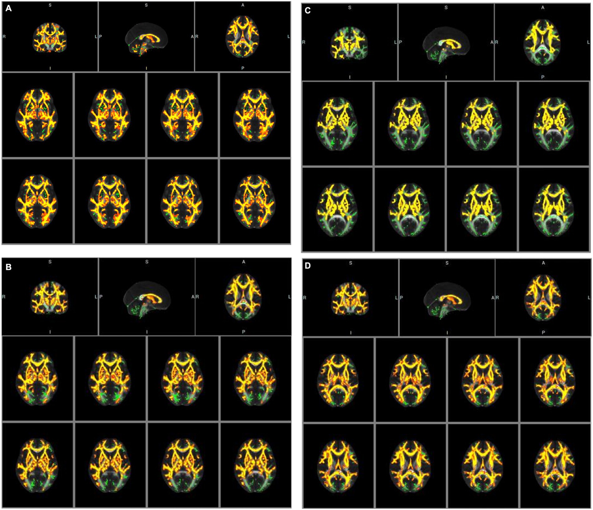 Four panels labeled A, B, C, and D, each displaying brain scans with variations in color patterns. The images feature axial, sagittal, and coronal views, highlighting different brain regions with color-coded areas, possibly indicating different levels of activity or connectivity. Each panel has a consistent format with a central sagittal view and multiple axial slices revealing detailed neural structures.