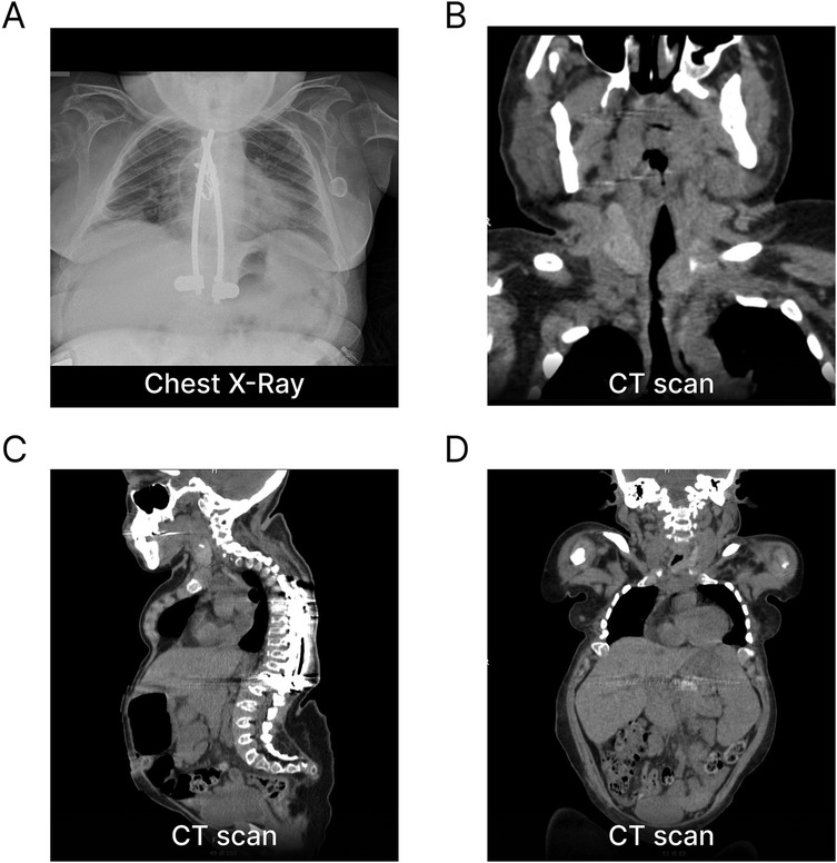 Panel A shows a chest X-ray displaying internal structures of the thoracic area. Panel B presents a CT scan with a cross-sectional view of the neck. Panel C provides a sagittal CT scan view of the spine and thorax. Panel D features a CT scan showing a coronal view of the upper body. Each image highlights different anatomical perspectives for medical analysis.