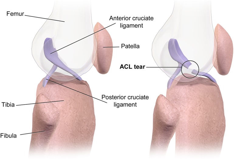 Diagram showing two views of the knee joint. The left image highlights the femur, tibia, fibula, patella, anterior cruciate ligament, and posterior cruciate ligament. The right image emphasizes the ACL tear within a circled area.