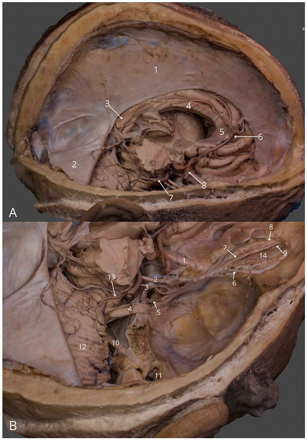 Cross-sectional images of a human torso showing anatomical structures. Image A focuses on a midsection view, with labeled parts indicating various organs and tissues. Image B illustrates a lower section with additional labels highlighting other internal structures. Both images provide a detailed study for educational purposes.