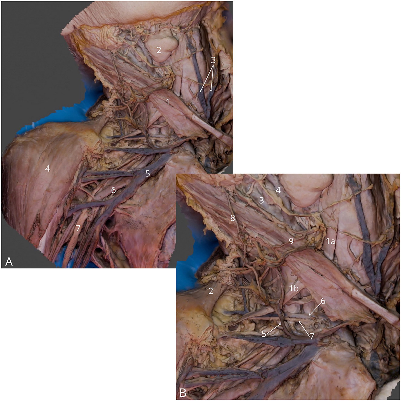 Anatomical dissection showing detailed structures of the human neck and shoulder region. The labels indicate various muscles, nerves, and blood vessels, marked with numbers for identification. Panel A focuses on the upper back and neck, while Panel B provides a closer view of the shoulder and lower neck, highlighting intricate anatomical features.