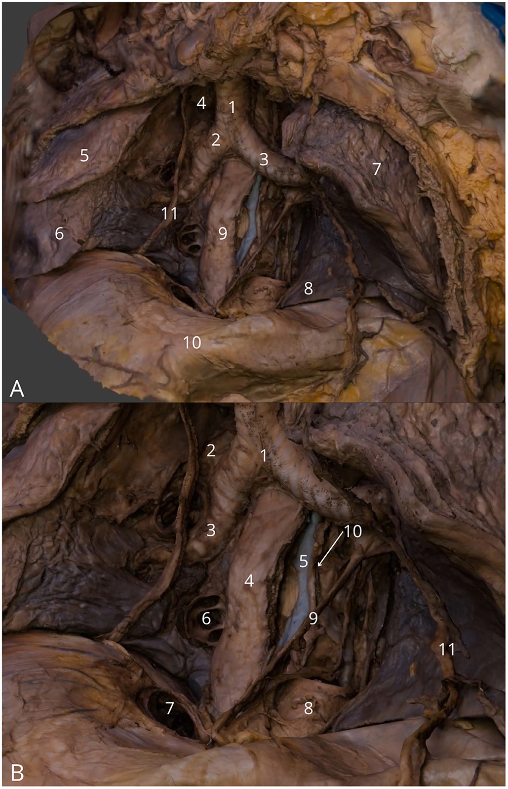 Dorsal view of the female pelvic cavity. Panel A shows an overview of the pelvic organs with various anatomical features labeled, including muscles and connective tissues. Panel B provides a closer detailed view, again labeling the significant structures, with emphasis on nerves and vessels. The image highlights key anatomical elements, numbered for reference.