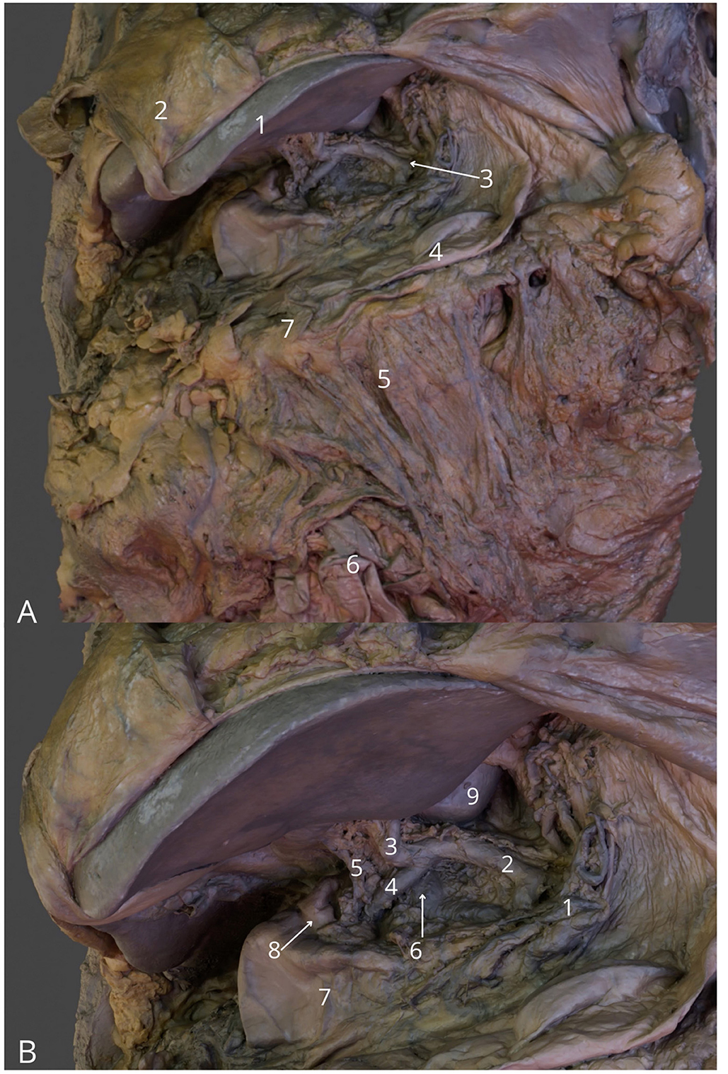 Anatomical dissection showing muscle and tissue structures with labels. Panel A displays seven numbered areas highlighting specific muscle groups and connective tissue. Panel B, below, features nine numbered areas providing detailed views of additional anatomical components. The colors of the tissue vary in shades of brown, pink, and green to indicate different tissues and layers.