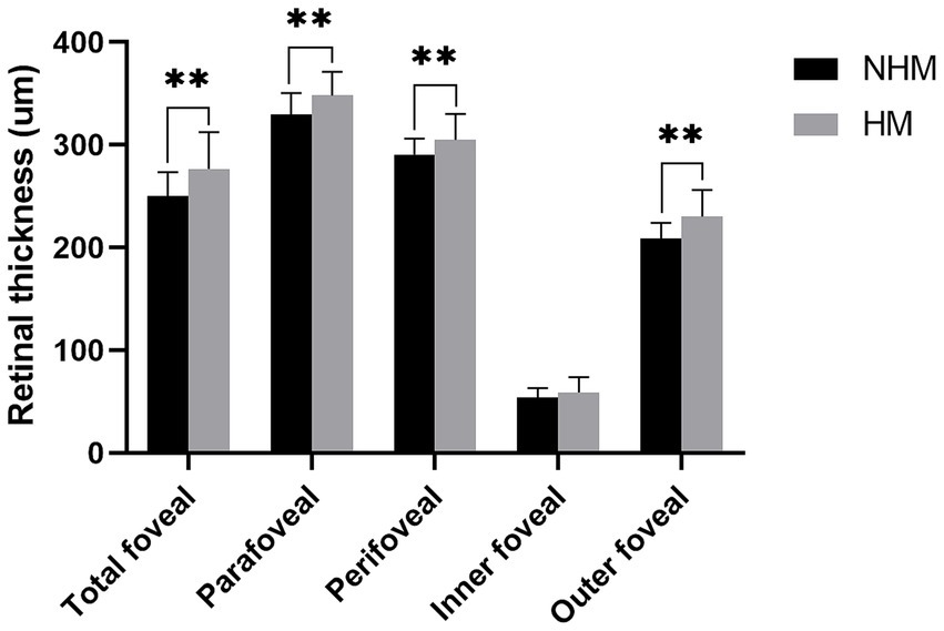 Bar chart comparing retinal thickness in micrometers between non-highly myopic (NHM) and highly myopic (HM) groups across five regions: total foveal, parafoveal, perifoveal, inner foveal, and outer foveal. Significant differences are indicated by asterisks, with NHM generally having lower retinal thickness compared to HM.