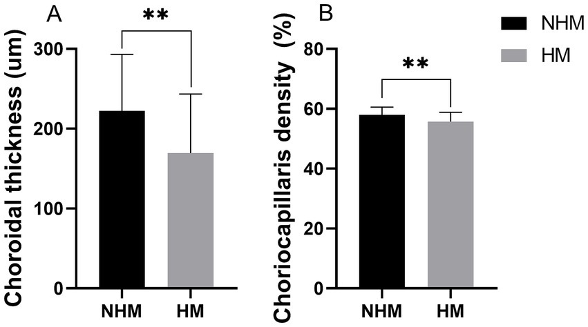 Bar graphs A and B compare NHM and HM. A shows choroidal thickness, with NHM significantly thicker than HM. B displays choriocapillaris density, also higher in NHM. Both differences are statistically significant, marked by a double asterisk.