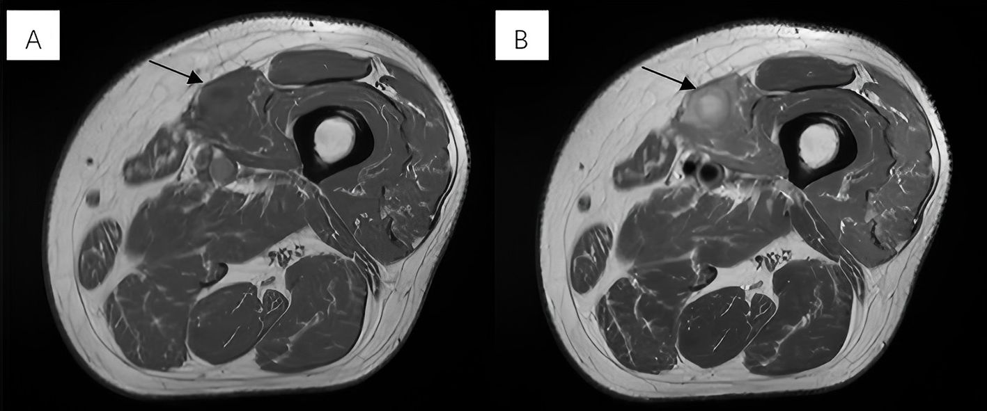 MRI scans labeled A and B show cross-sections of tissue with arrows pointing to specific areas of interest. Images show the signal intensity of the lesions on different sequences.