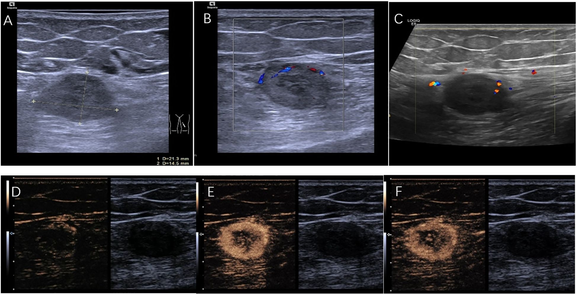 Image A shows the two-dimensional ultrasound findings. Images B and C show the color Doppler ultrasound findings. Images D, E, and F show the performance of contrast-enhanced ultrasound at different phases.