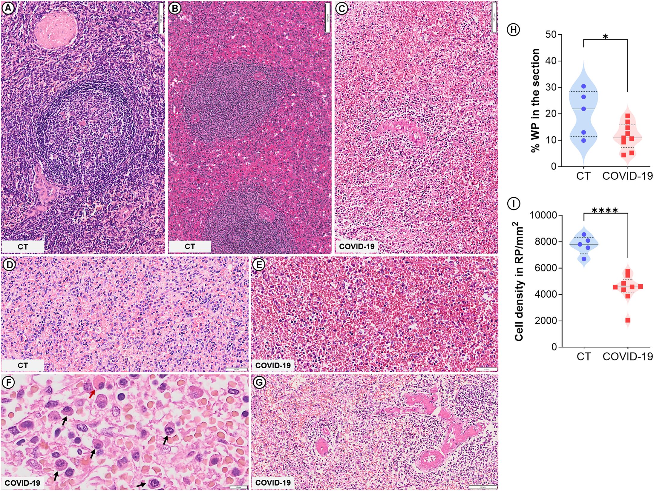 Microscopic images A to G display tissue samples from CT and COVID-19 cases, showing structural differences in cell distribution and density. Two graphs, H and I, depict statistical comparisons. Graph H shows a decrease in the percentage of WP in COVID-19 cases. Graph I indicates lower cell density in COVID-19 samples compared to CT, with significance noted by asterisks.