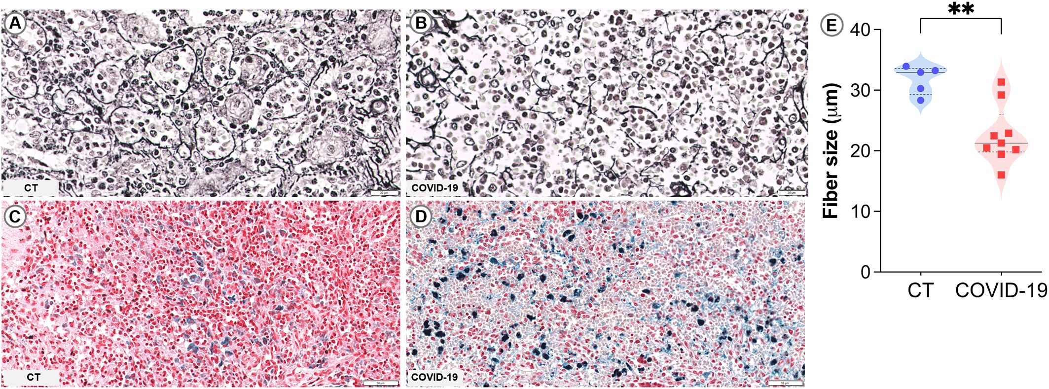 Four microscopic images (A, B, C, D) compare tissue samples: A and B display normal and COVID-19 affected tissues stained black, showing structural differences. C and D feature tissue sections stained red and blue, highlighting iron distribution in control versus COVID-19 conditions. Panel E is a violin plot showing fiber size differences between control and COVID-19 samples, with COVID-19 exhibiting a significant reduction.