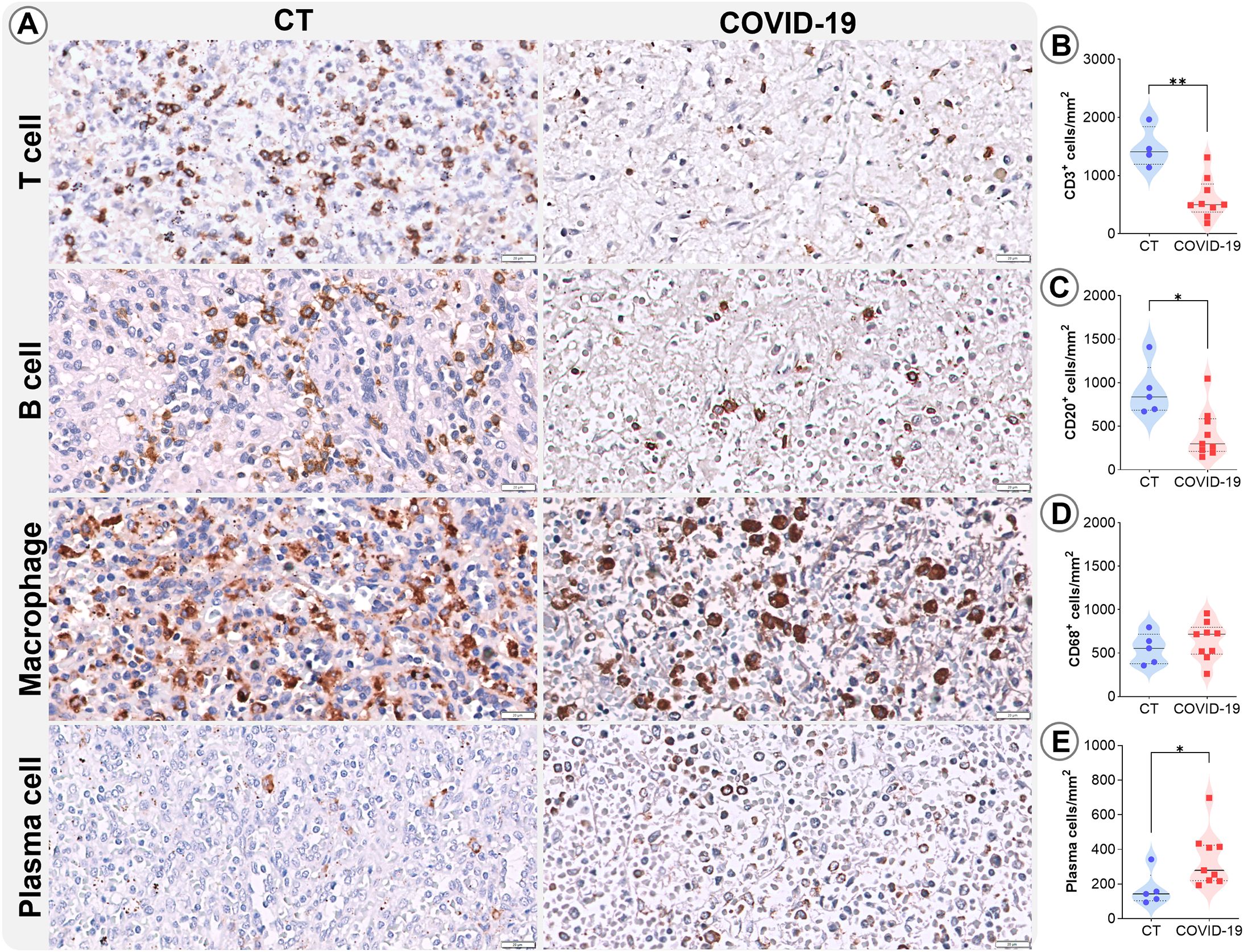 Histological analysis comparing immune cell presence in control (CT) and COVID-19 affected tissues. Panels labeled T, B, macrophage, and plasma cells show stained tissue images. Control samples exhibit denser staining compared to COVID-19 samples, indicating differences in cell density. Adjacent graphs (B to E) display violin plots quantifying cell counts for CD3+ T cells, CD20+ B cells, CD68+ macrophages, and plasma cells. Significant differences are marked with asterisks, indicating reduced cell densities in COVID-19 samples compared to controls.