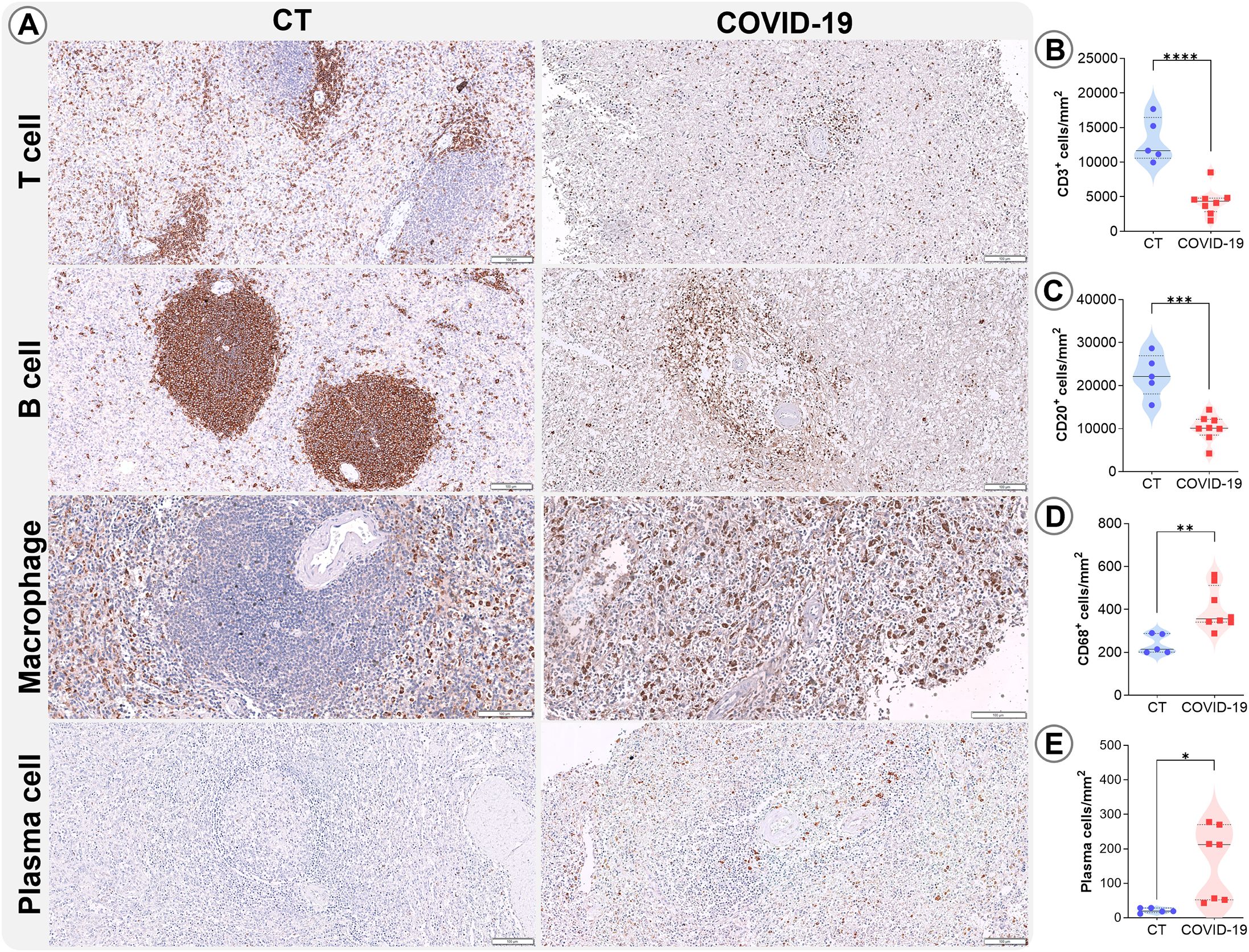Histological comparison of spleen tissue between control (CT) and COVID-19. Panels include T cell, B cell, macrophage, and plasma cell images, with more intense staining in CT than COVID-19. Adjacent violin plots depict cell count differences, with CT showing higher CD3+, CD20+, they are reduced in the control group compared to COVID-19, indicated by significance levels.