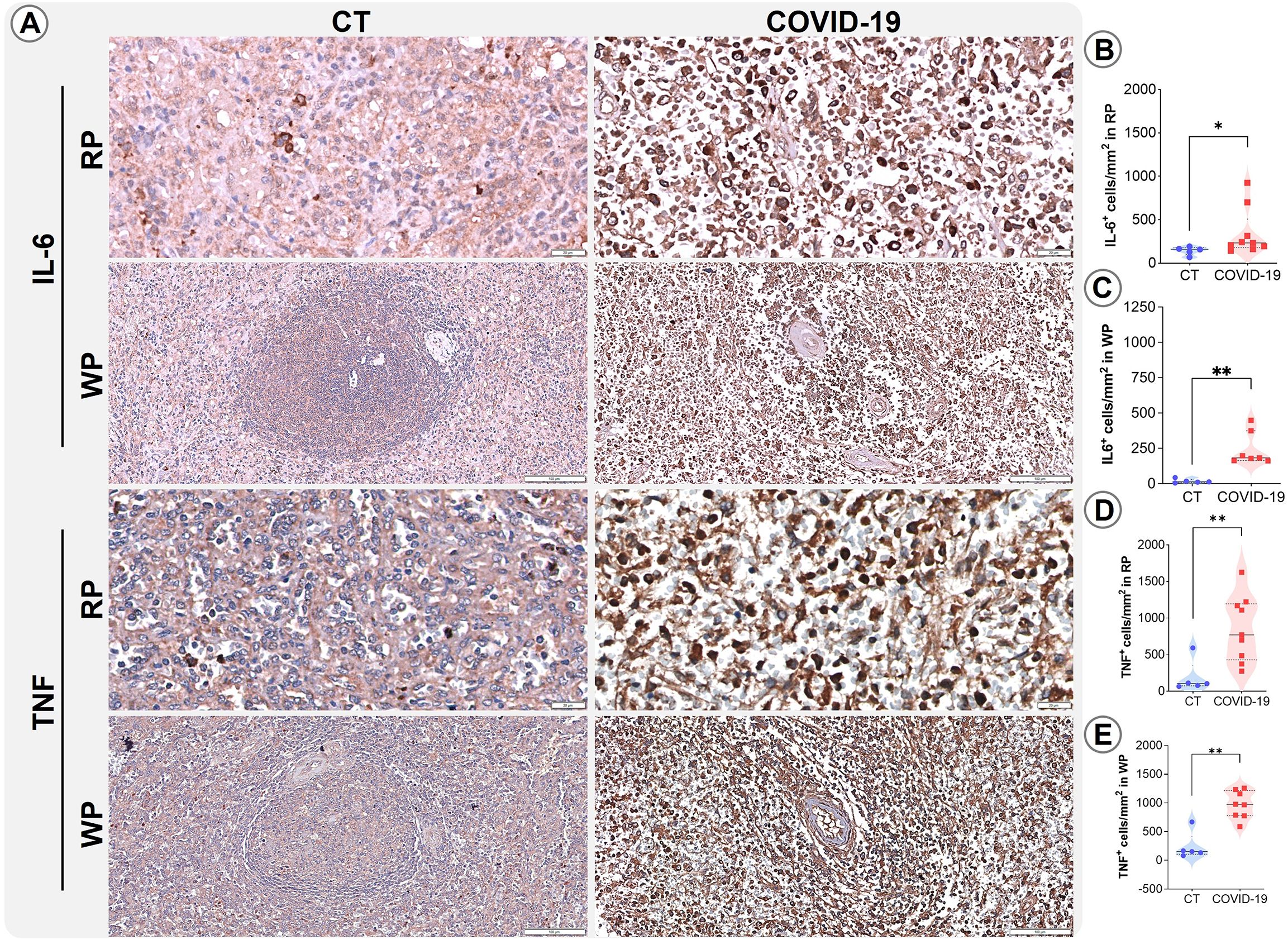 Histological comparison of spleen tissues from control (CT) and COVID-19 patients showing IL-6 and TNF expression. Panels A display tissue sections: rows IL-6 (RP, WP) and TNF (RP, WP) for CT and COVID-19. Panels B to E show corresponding quantitative graphs, indicating increased IL-6 and TNF levels in COVID-19 tissues. Significant differences are marked with asterisks.