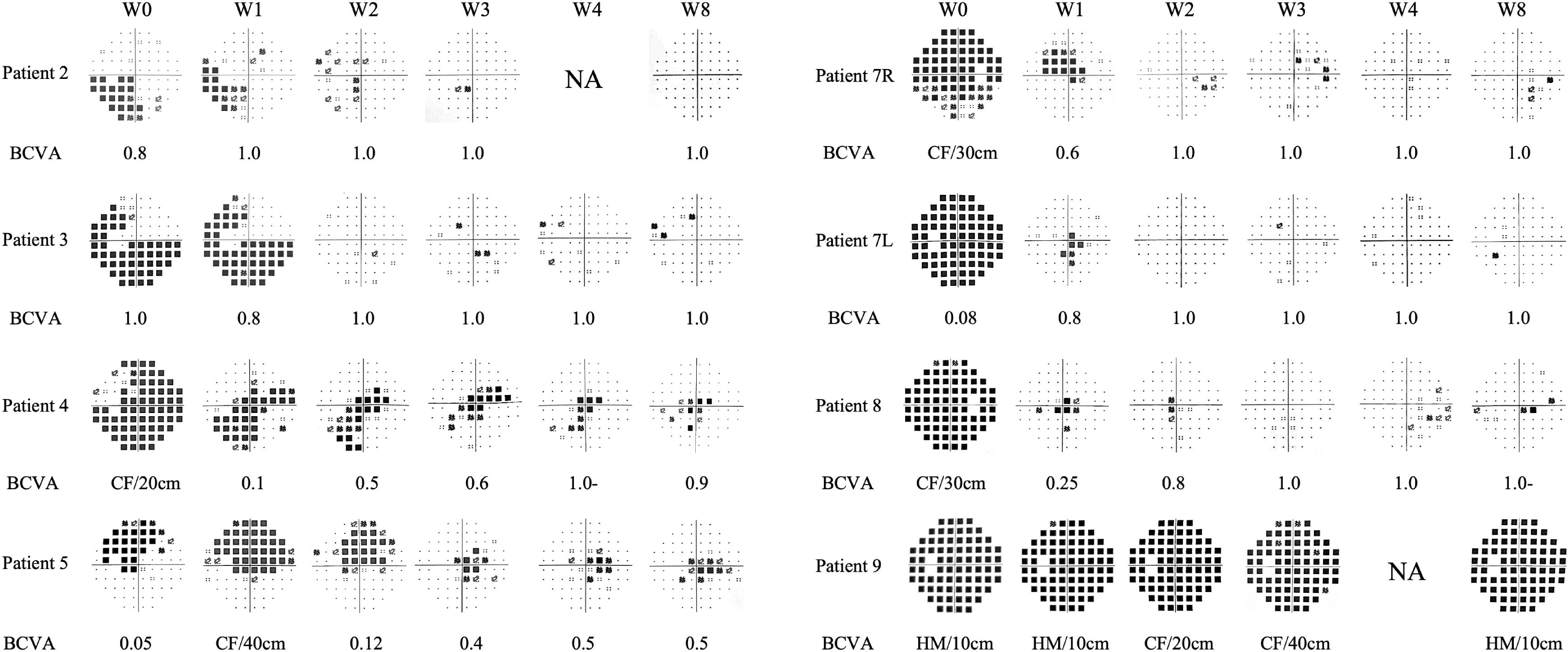 Visual field test results for multiple patients over several weeks (W0, W1, W2, W3, W4, W8). Patients labeled (e.g., Patient 2, Patient 3) show progressing diagrams. BCVA values are noted below each test as numerical values or visual acuity descriptors (such as CF for counting fingers, HM for hand movements), indicating changes or stability in vision over time. The image highlights variations in light perception and areas of the eye responding to stimulation.