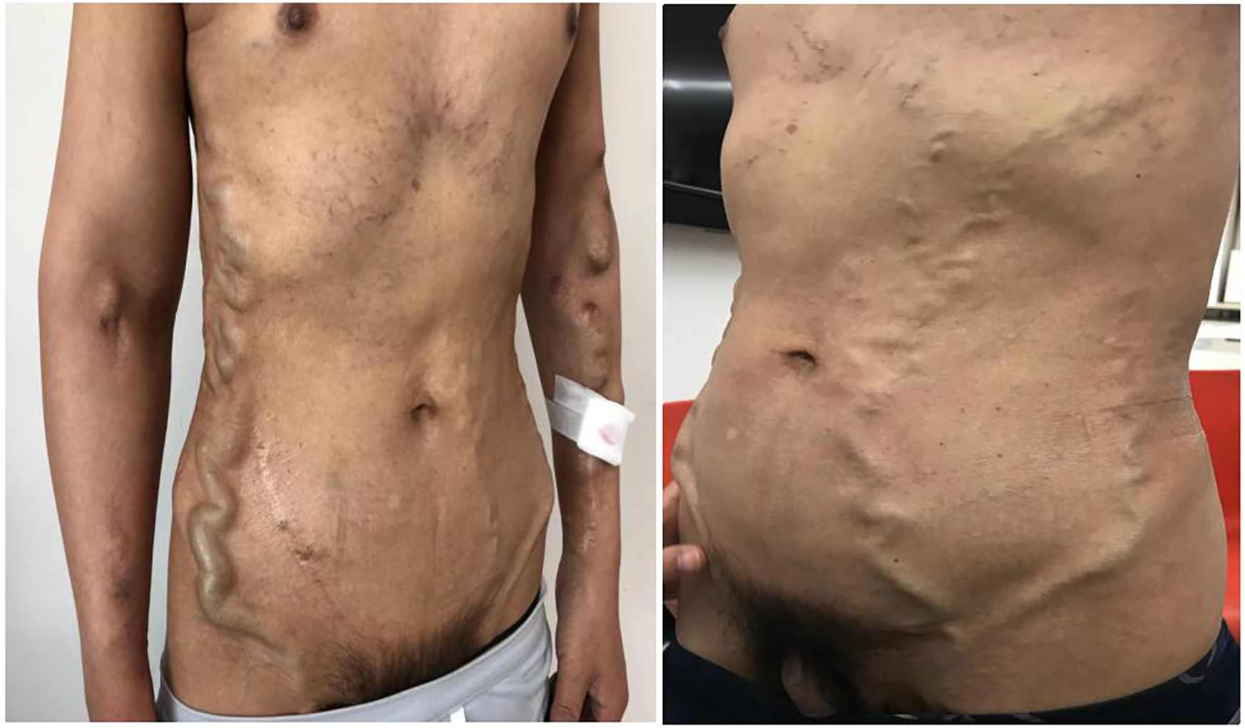 Two images show a person's torso with prominent and irregular veins visible on the skin. The left image displays the side and lower chest, while the right image shows a close-up of the abdomen.
