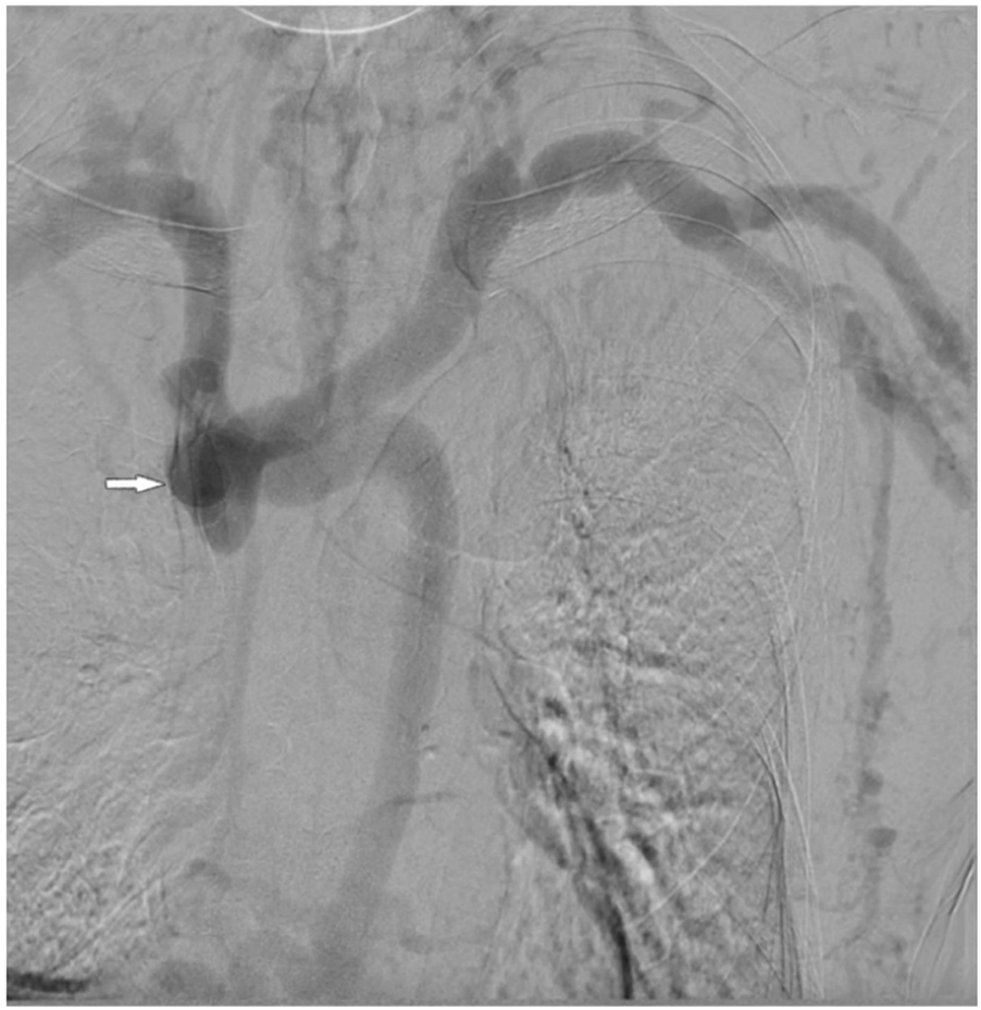 Digital subtraction angiography revealed a complete occlusion of the superior vena cava occlusion. A marked bulge is indicated by an arrow, suggesting the initial occlusion of the superior vena cava occlusion.