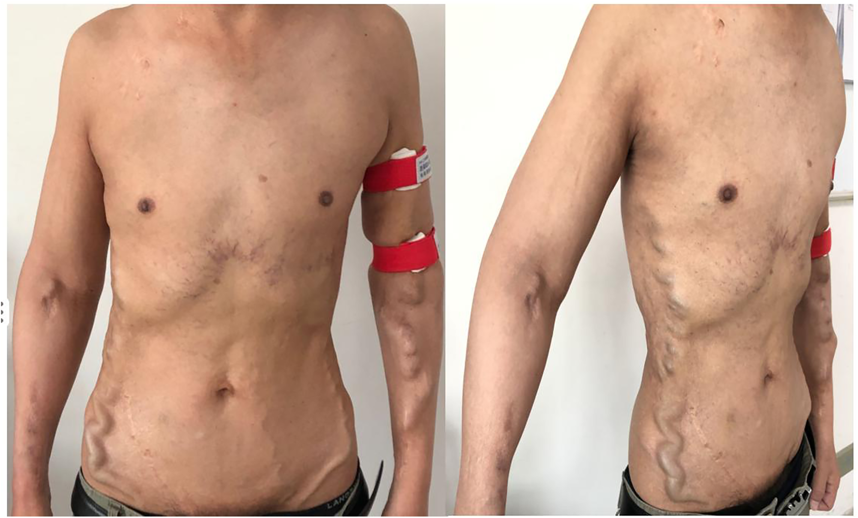 The patient present dilated thoracoabdominal and epigastric veins.