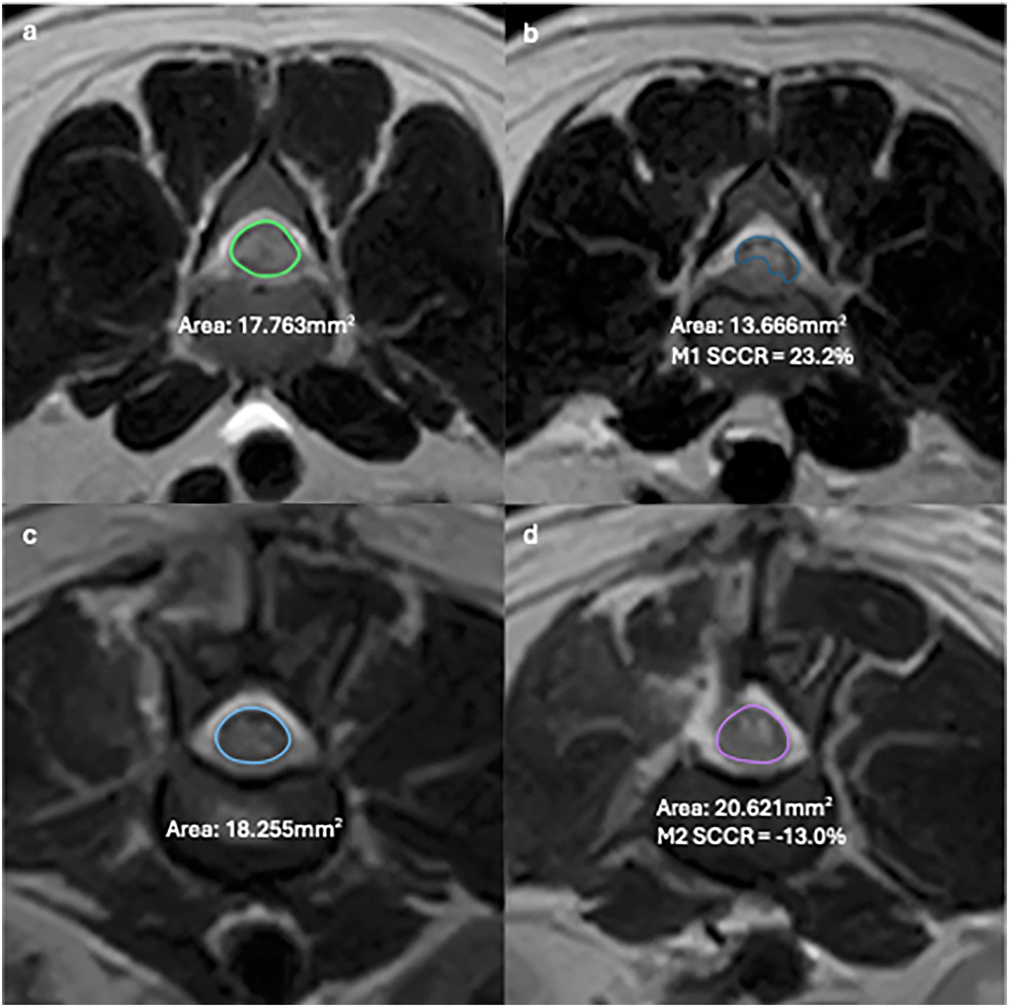 Four MRI scans labeled a to d, showing cross-sectional views with highlighted areas. Image a: green outline, area 17.763 square millimeters. Image b: blue outline, area 13.666 square millimeters, with M1 SCCR of 23.2 percent. Image c: blue outline, area 18.255 square millimeters. Image d: purple outline, area 20.621 square millimeters, with M2 SCCR of negative 13.0 percent.
