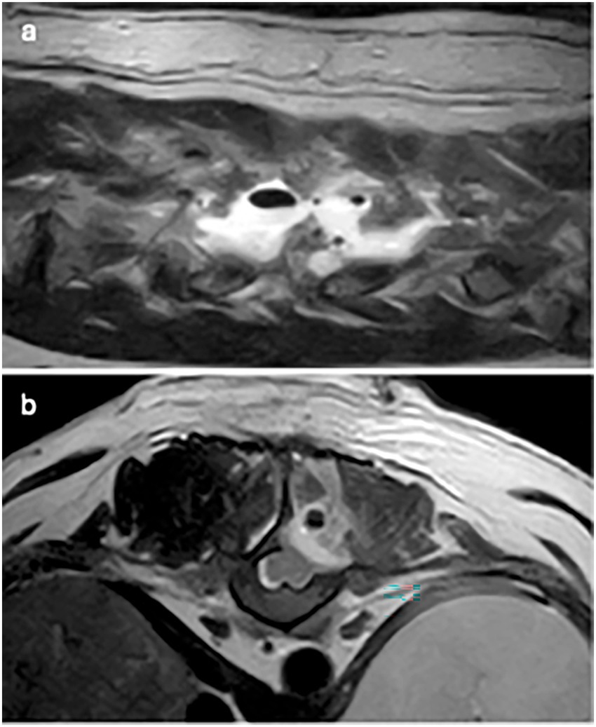 MRI images in two panels. Panel (a) shows a sagittal view of the lower thoracic spine with heterogeneous signal intensities suggestive of a spinal abnormality. Panel (b) displays an axial view highlighting asymmetry and suspicious areas in the soft tissues surrounding the vertebrae.