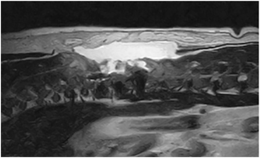The MRI image shows a sagittal view of the thoracolumbar spine with high signal intensity suggestive of fluid accumulation.