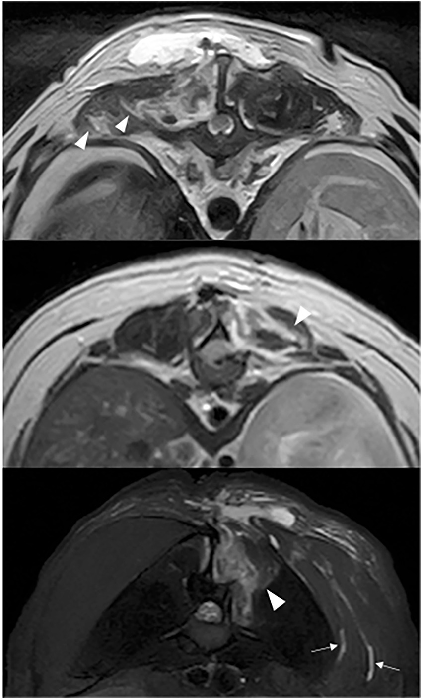 Three different MRI scans of the chest, displaying the thoracic region. Each image highlights a specific area with white arrowheads pointing to regions of interest. The upper and middle images focus on soft tissue structures, while the lower image, which includes arrows, may indicate a pathology involving deeper tissues or bone structure.