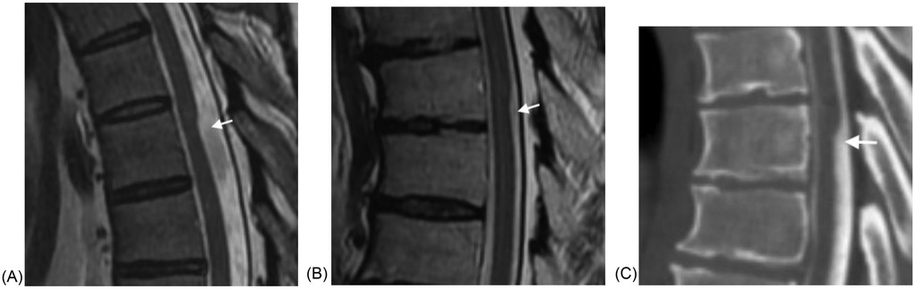 Three medical images display spinal structures with arrows indicating specific areas. Image (A) and (B) show sagittal MRI scans highlighting arachnoid webs and the spinal cord. Image (C) is a CT myelogram focusing on an arachnoid web and the spinal cord.