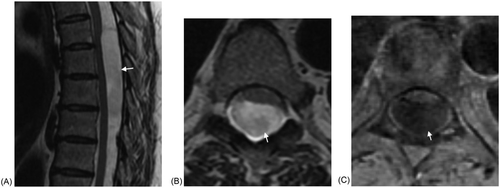 Three MRI images show spinal abnormalities. Image (A) depicts a sagittal view with an arrow pointing to an arachnoid cyst. Image (B) presents an axial view with an arrow pointing to the arachnoid cyst. Image (C) shows another axial sequence with an arrow pointing to the arachnoid cyst.