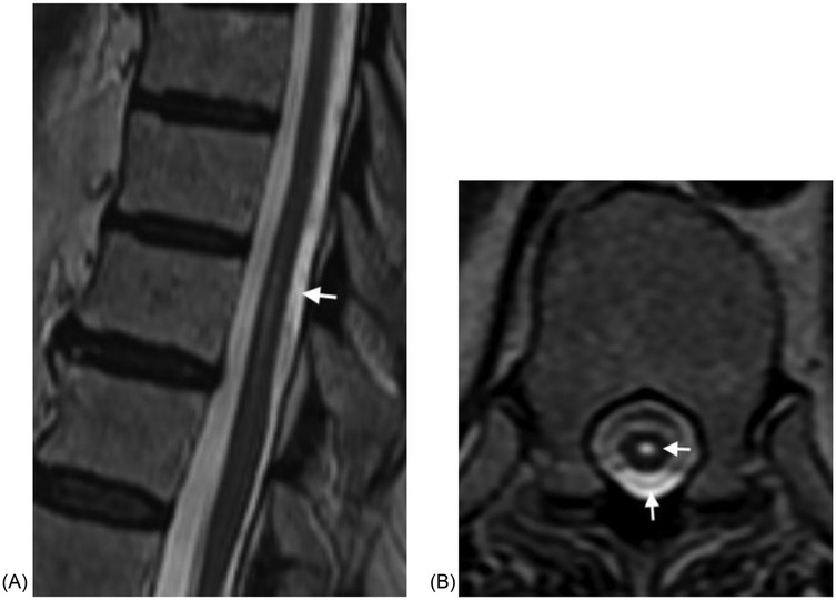 MRI images of the lumbar spine. Image (A) shows a sagittal view highlighting an arachnoid cyst with an arrow. Image (B) provides an axial view demonstrating syringomyelia.