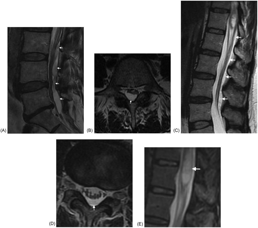 MRI images of the lumbar spine. Image (A) and (C) are sagittal views, each with an arrow pointing to a spinal arachnoid cyst. Image (B) and (D) are axial views, each with an arrow pointing to a spinal arachnoid cyst. Image (E) is a sagittal view with an arrow highlighting syringomyelia.