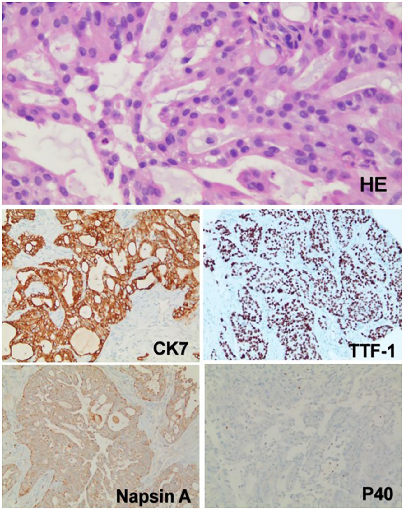 Histological analysis displays four panels: Top shows Hematoxylin and Eosin staining with purple cell nuclei. Lower left, CK7 highlights cell membranes in brown. Lower center, Napsin A stains tissue sections. Lower right, P40 panel shows minimal staining.
