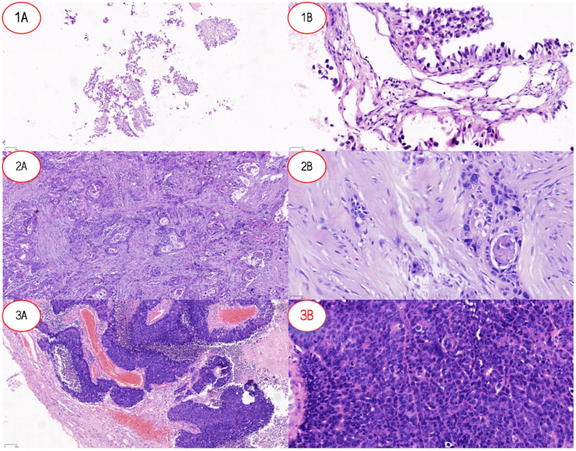 Microscopic images showing various tissue samples. Panel 1A depicts dispersed small clusters of cells. Panel 1B shows tubular structures with closely packed cells. Panel 2A illustrates dense fibrous tissue with irregularly shaped clusters. Panel 2B focuses on fibrous tissue with embedded oval cells. Panel 3A features tissue with distinct, curved formations and cellular clusters. Panel 3B highlights densely packed cells with distinct nuclei.
