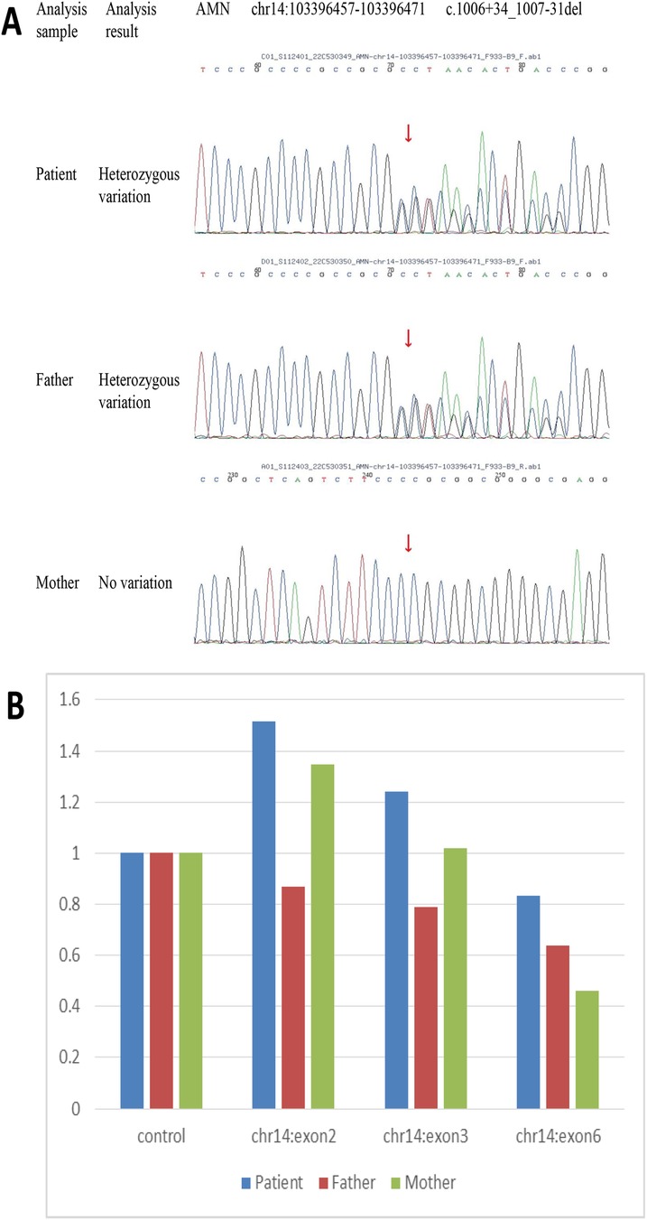 Panel A shows DNA sequencing chromatograms for a patient, father, and mother. The patient and father show heterozygous variations indicated by arrows, while the mother shows no variation. Panel B is a bar chart comparing genetic data between the patient, father, and mother across four categories: control, chr14:exon2, chr14:exon3, and chr14:exon6. Each category is represented by three bars indicating different levels for the patient, father, and mother.