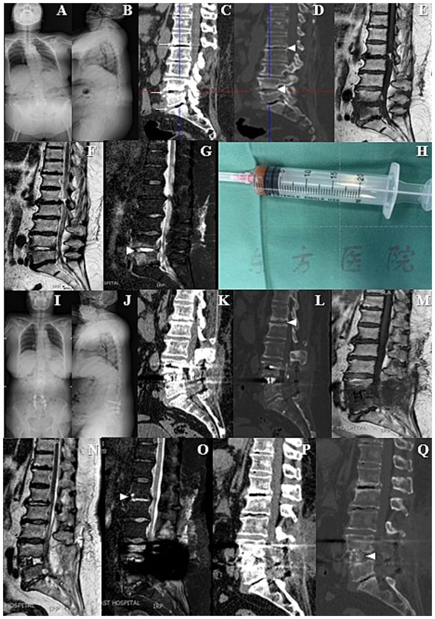 Composite medical image featuring multiple X-rays and MRI scans of a spinal column, highlighting different angles and conditions of the vertebrae. A syringe filled with a colored liquid is also displayed on a green surgical cloth. Labels 'A' to 'Q' mark each distinct part of the composite, showing varying stages and perspectives of spinal analysis.