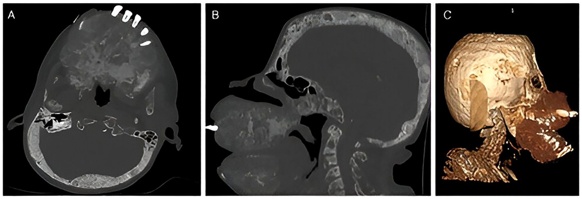 CT scan images showing a skull from different angles. Image A displays an axial view. Image B presents a sagittal view. Image C shows a 3D reconstruction, highlighting bone structures.