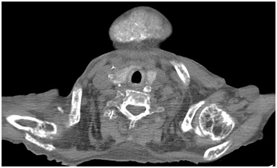 CT scan of the neck showing a large mass at the top center, with a clear circular area below it indicating the trachea. The scan reveals surrounding structures and tissues with varying densities.