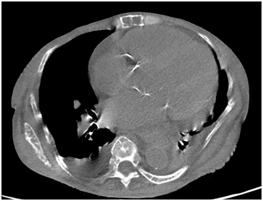 CT scan image showing a cross-sectional view of the chest cavity. The scan reveals the heart, demonstrating significant cardiomegaly, with surrounding thoracic structures visible in the grayscale image. The previous description of a ‘large, dense mass’ could be misinterpreted as a pathological mass rather than an enlarged heart.