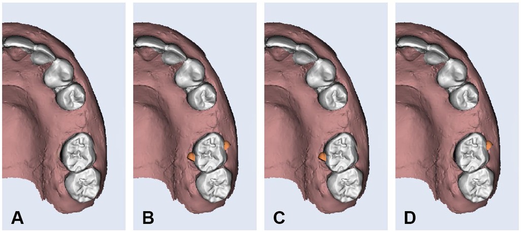Digital models of the upper jaw, showing dental arch from different angles labeled A to D. Teeth are rendered in white, jaw in pink. Small orange markers appear around the molars in images B, C, and D.