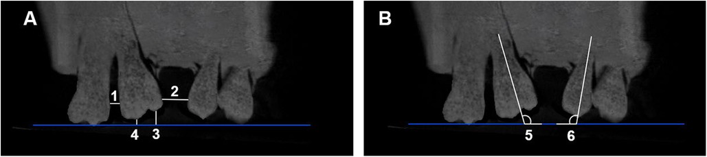 Dental radiograph with labeled measurements on two panels, A and B. Panel A shows measurements 1 to 4 along the roots of two adjacent teeth. Panel B displays measurements 5 and 6 with visible angles from the roots to a blue line, representing the baseline.