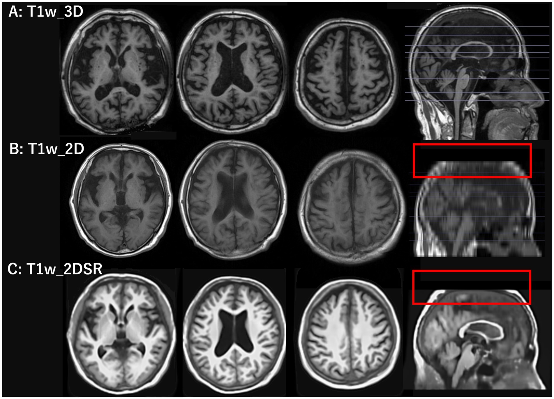 MRI images of the human brain show axial views in three types: T1w 3D (A), T1w 2D (B), and T1w_2DSR (C). Each row displays different imaging sequences highlighting brain structures. Sagittal views with red boxes appear on the right, emphasizing specific brain regions.