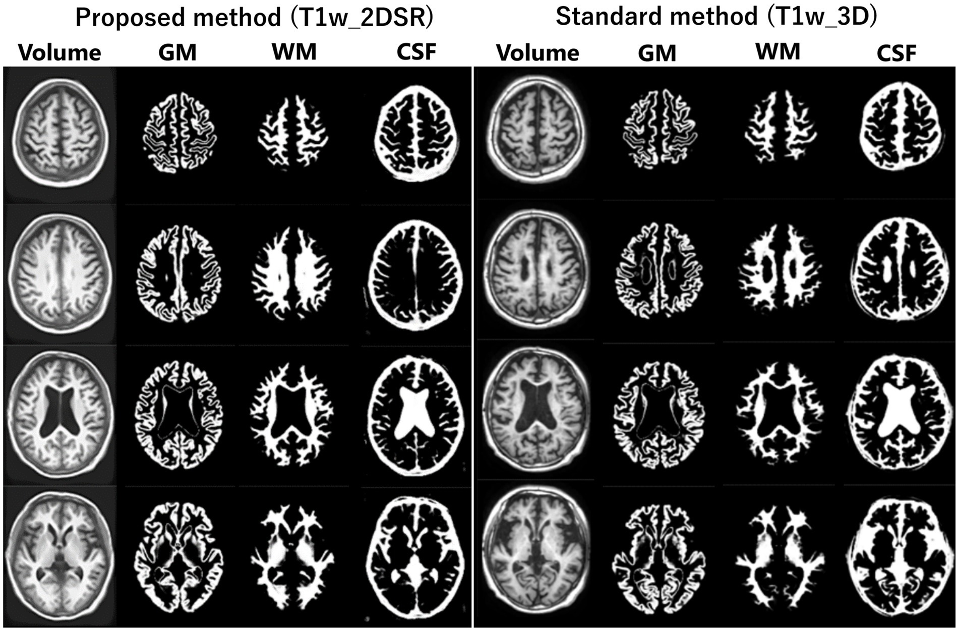 Comparison of brain MRI slices using two methods: Proposed method (T1w 2DSR) on the left and Standard method (T1w 3D) on the right. Each row displays volume images followed by segmented images of gray matter (GM), white matter (WM), and cerebrospinal fluid (CSF). Differences in segmentation clarity and detail between the proposed and standard methods are evident.