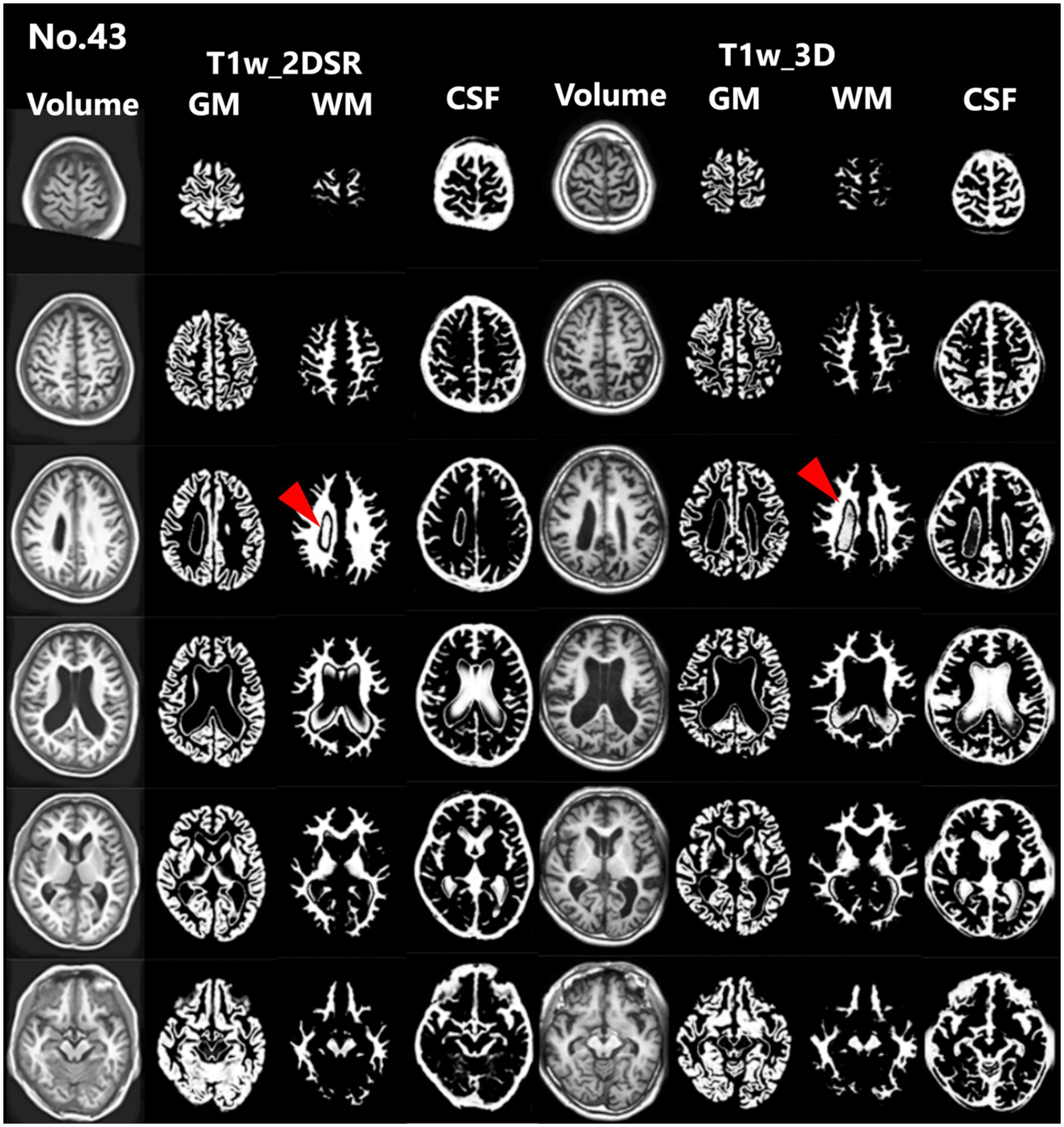 Brain MRI scans showing cross-sectional views with different imaging sequences: T1w 2DSR and T1w 3D. Images display volume, gray matter (GM), white matter (WM), and cerebrospinal fluid (CSF). Red arrows highlight specific regions in some panels.