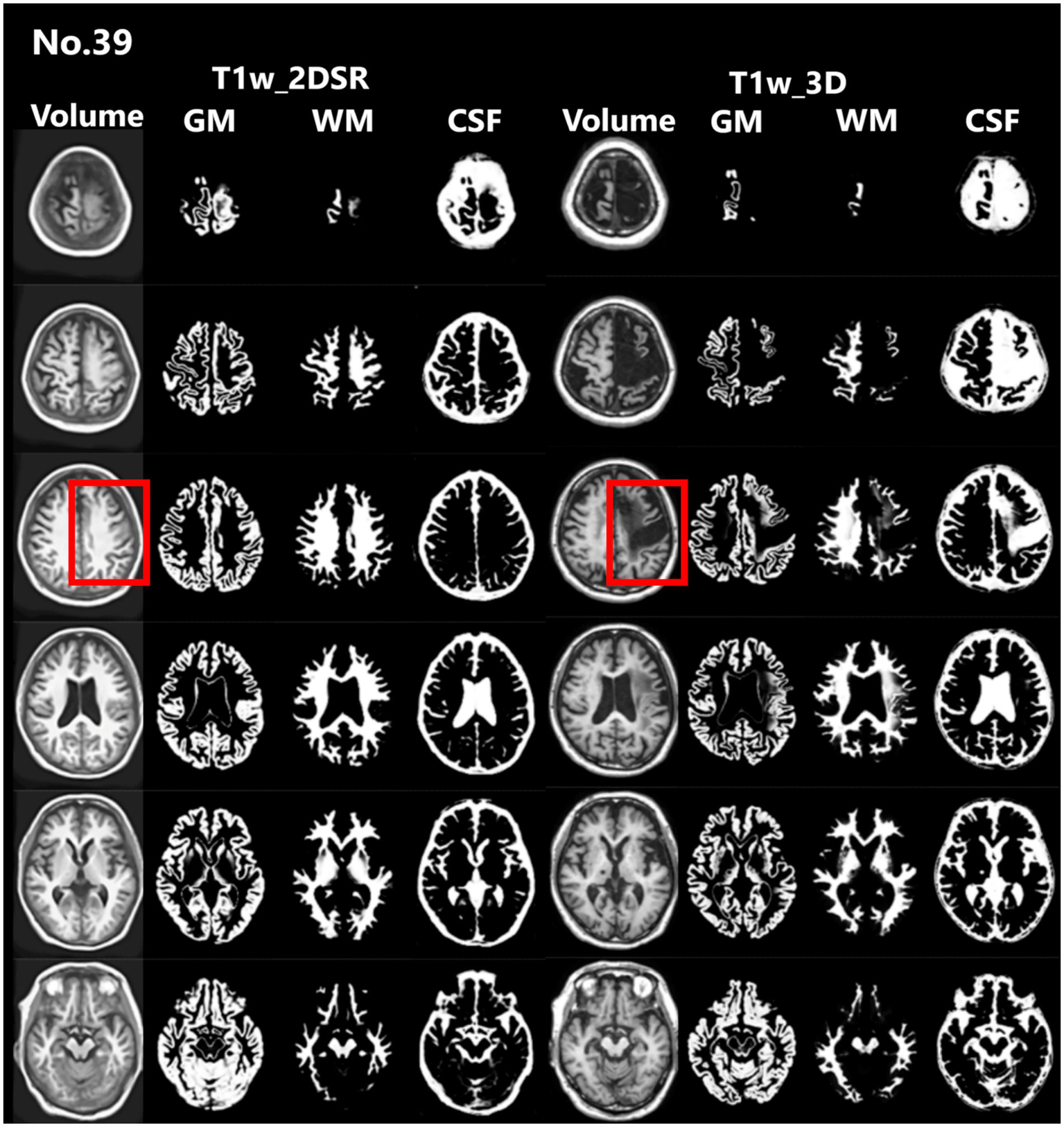 MRI brain scans are arranged in a grid, showing different slices and contrasts. Rows are divided into Volume, GM, WM, and CSF. Two images are highlighted with red boxes, indicating specific areas of interest for both T1w 2DSR and T1w 3D views.