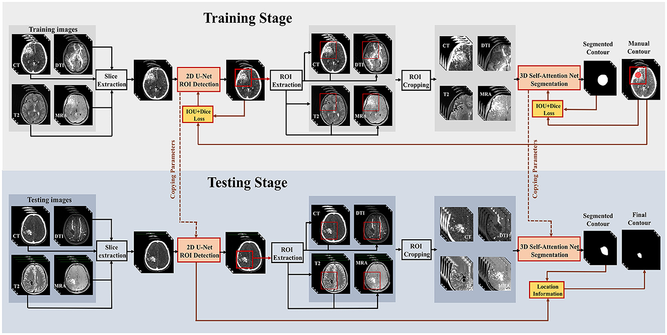 Flowchart illustrating the training and testing stages of a brain imaging process. In the training stage, images such as CT, DTI, T2, and MRA are used for slice extraction, followed by 2D U-Net ROI detection. ROI extraction and cropping are performed, and 3D Self-Attention Net segmentation results in segmented contours. The testing stage mirrors this process, using the same image types and methods, leading to final contour segmentation. IOU and Dice Loss metrics, along with location information, guide the segmentation accuracy.