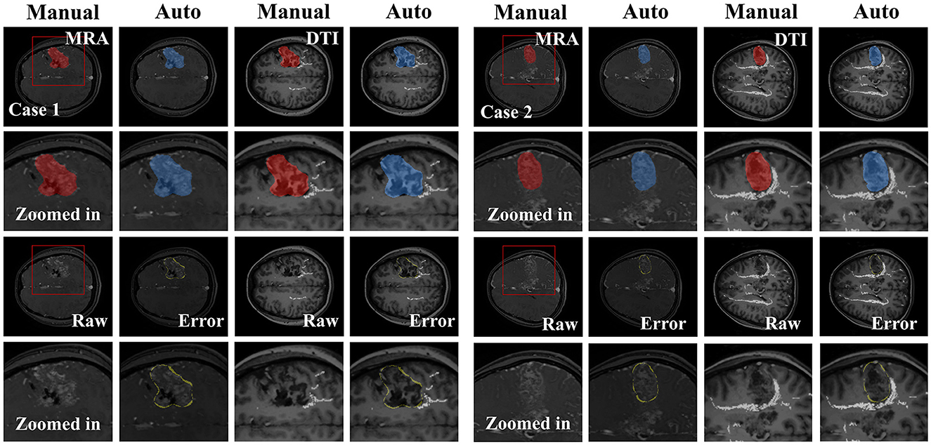 MRI images comparing manual and automated segmentation methods for two cases, using MRA and DTI techniques. Each case includes original, zoomed, raw, and error images in both red and blue color highlights to indicate different analyses.